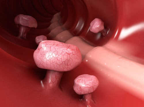 Polypectomy 1