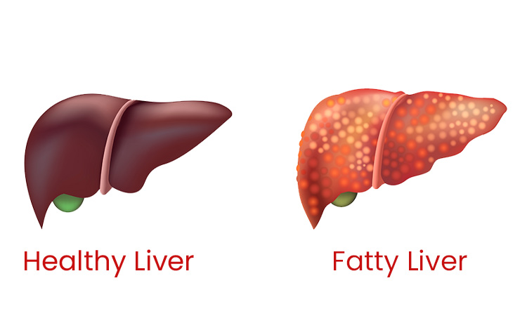 Liver Disease Treatment in Bilaspur